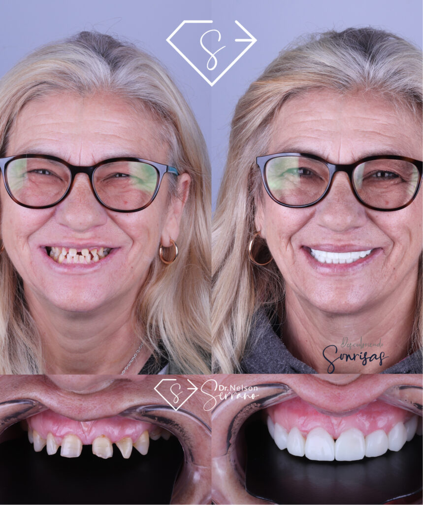 Serrano Dental Care - Diseño de Sonrisa 1