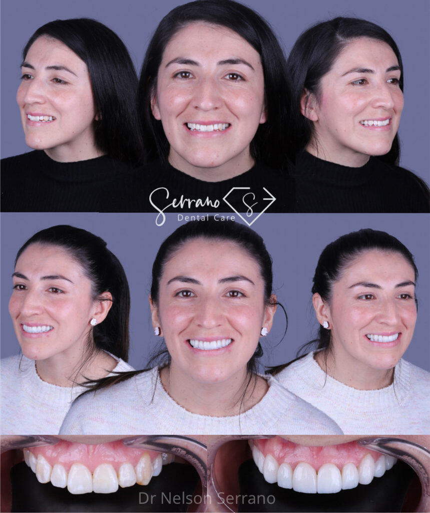 Serrano Dental Care - Diseño de Sonrisa 2