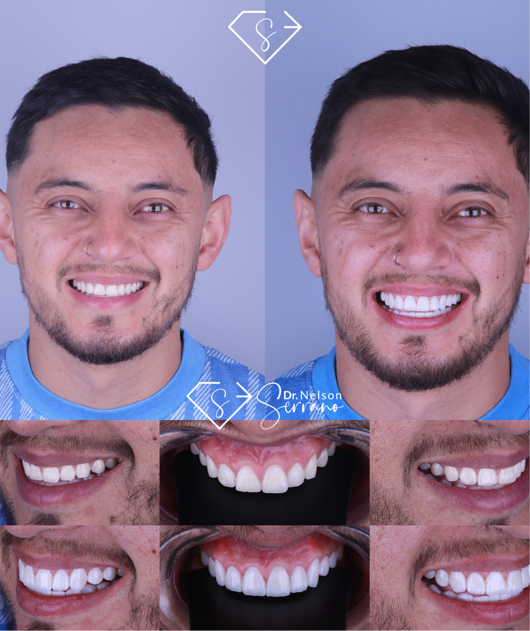 Serrano Dental Care - Diseño de Sonrisa 3