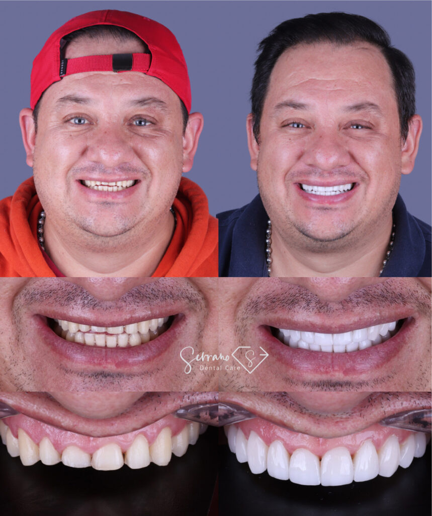 Serrano Dental Care - Diseño de Sonrisa 4