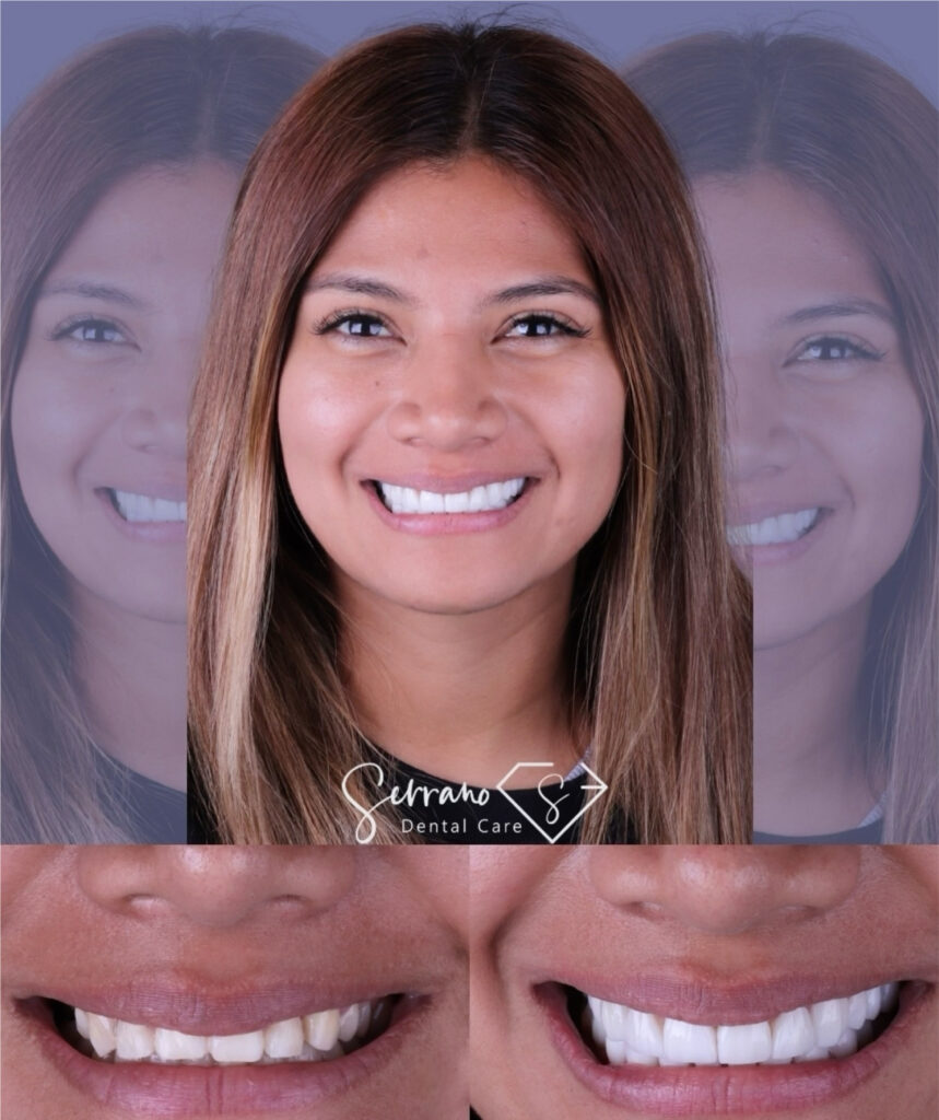 Serrano Dental Care - Diseño de Sonrisa 5