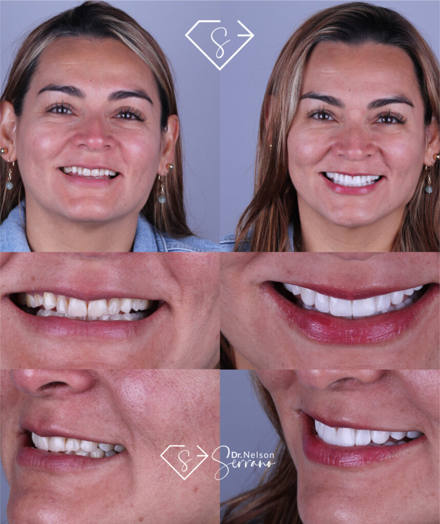 Serrano Dental Care - Diseño de Sonrisa 6